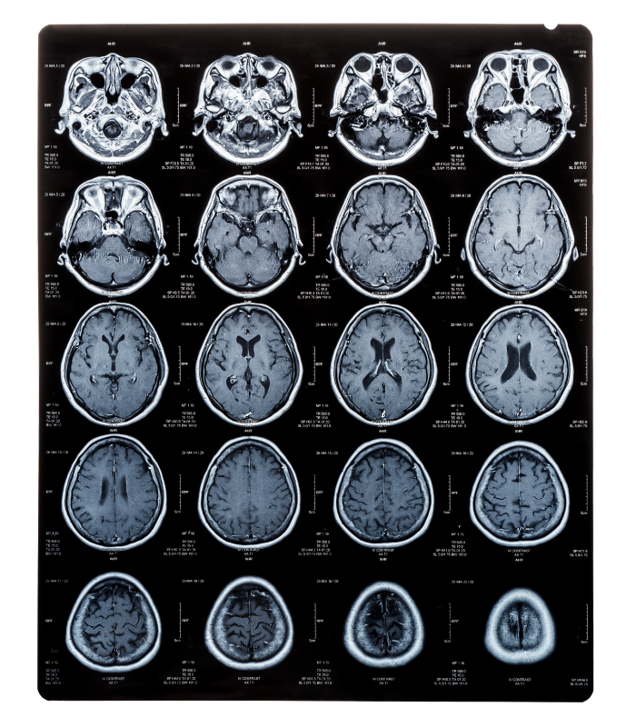 radiografia_migraña.png